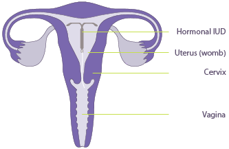 Ultrasound Mirena Embedment